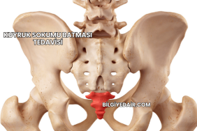 Kuyruk Sokumu Batması Tedavisi