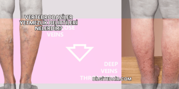 Vertebrobaziler Yetmezlik Belirtileri Nelerdir?